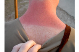 Россиянам дали советы, как спасти обгоревшую на солнце кожу