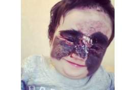 Российские врачи сделали еще одну операцию американской девочке с родимым пятном на все лицо