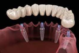 В СПб стоматологи наблюдают интерес пациентов к протезированию по системе «Все на четырех» (All on 4)