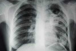 Врач спрогнозировал в мире эпидемию туберкулеза