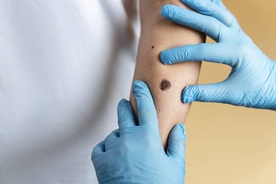 Персонализированную вакцину против меланомы начали испытывать на перенесших заболевание людях