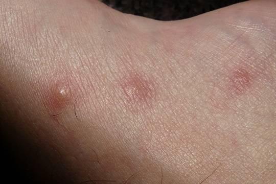 По Европе распространяется опасный супергрибок